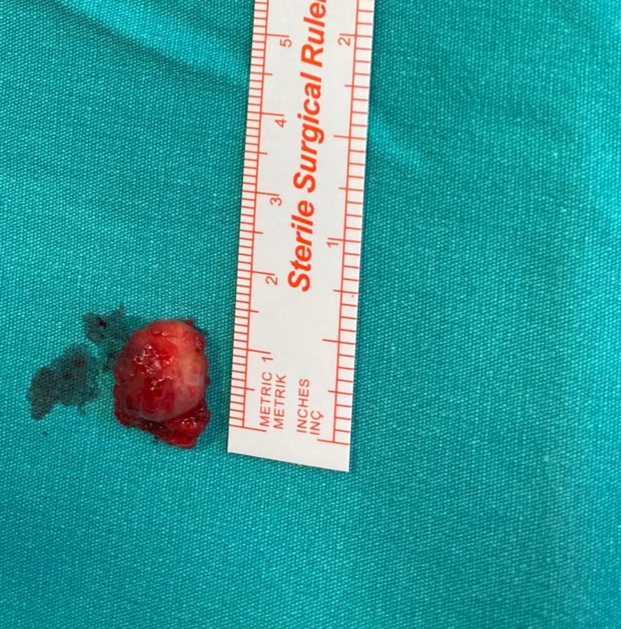 Çıkarılan tümör - Göğüs duvarı leiomyoması