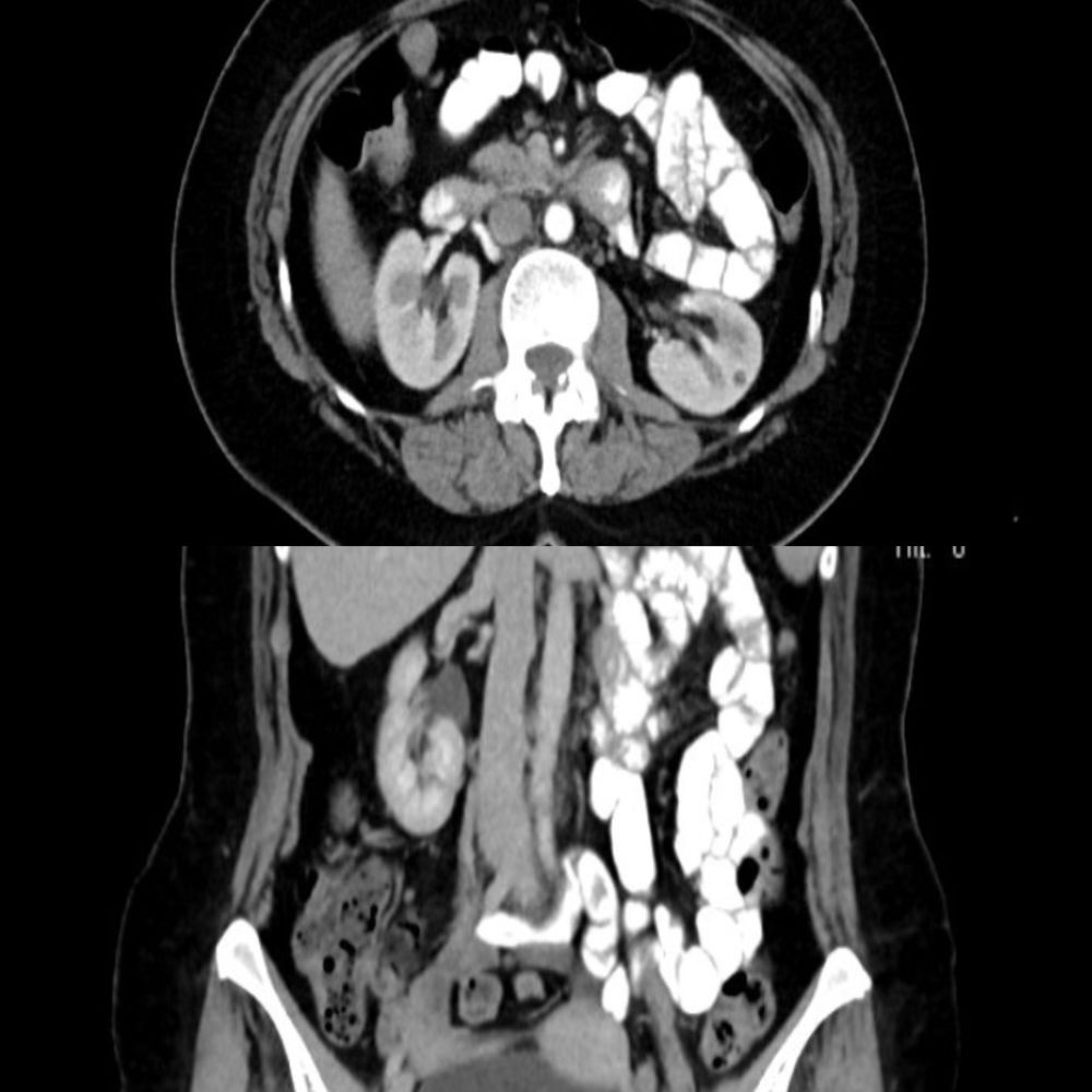 Hastanın tomografi görüntüsü - Göğüs duvarı leiomyoması